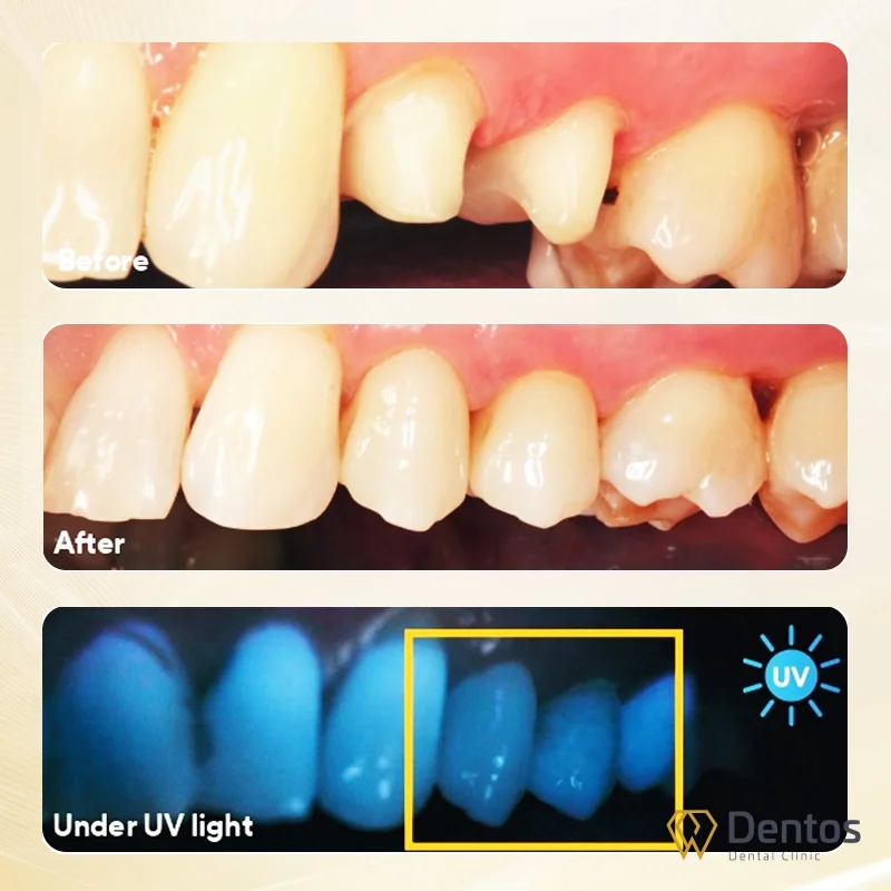 Khả năng huỳnh quang tự nhiên của răng sứ Lava Esthetic